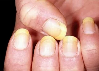 How To Get Rid of Yellow Nails Effectively